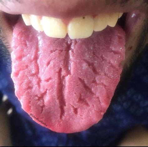 Lingua fissurata (lingua plicata, scrotal tongue, fissured tongue).